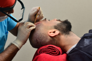 Hair transplant in Dubai