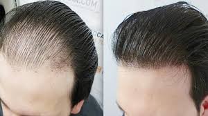 تكلفة زراعة الشعر