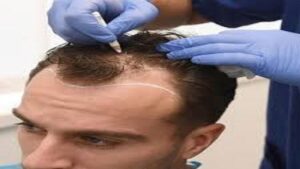 زراعة الشعر في دبي