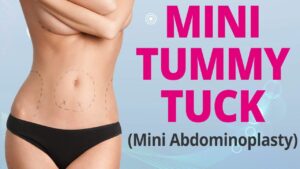 Mini Tummy Tuck in Dubai