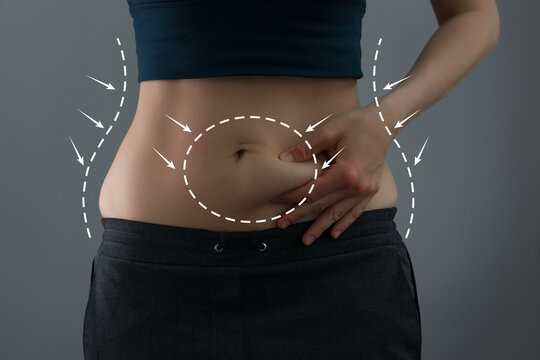 tummy tuck in Dubai