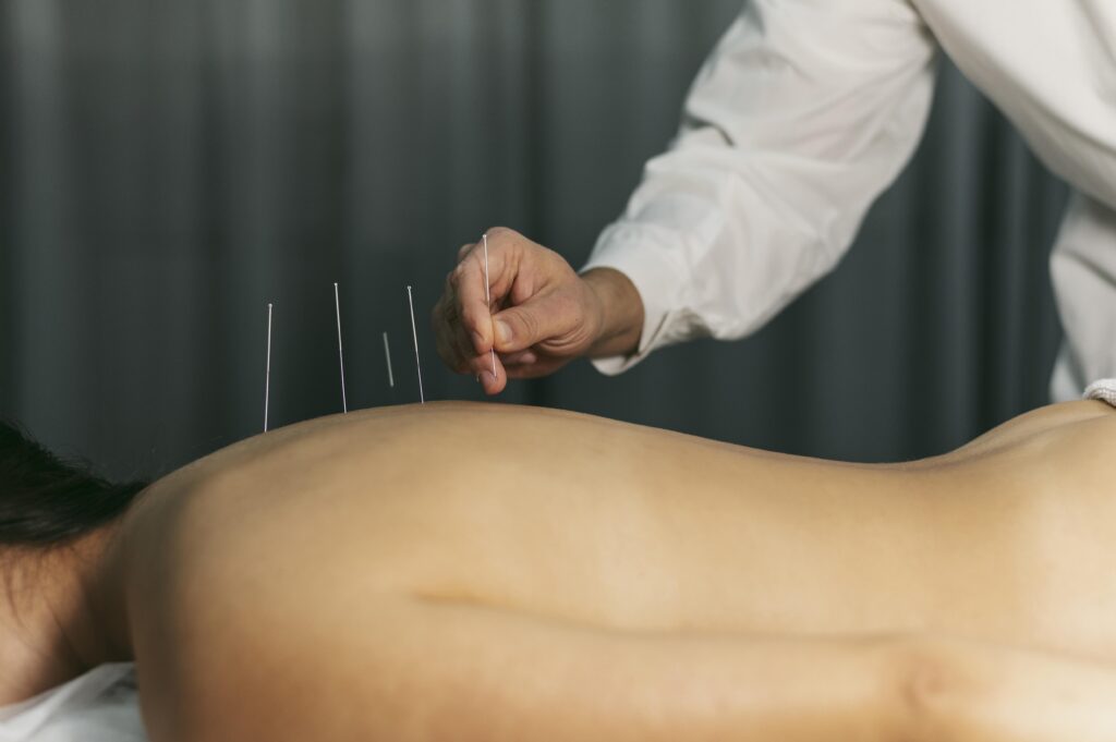 Acupuncture for back pain