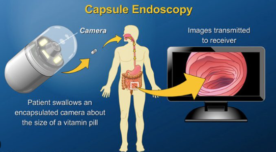 Colon Capsule Endoscopy Market Research by 2022-2028 | Given Imaging (Medtronic Plc), Olympus Corporation, IntroMedic, Co. Ltd.