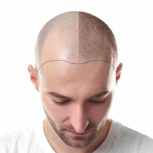زراعة الشعر في الرياض