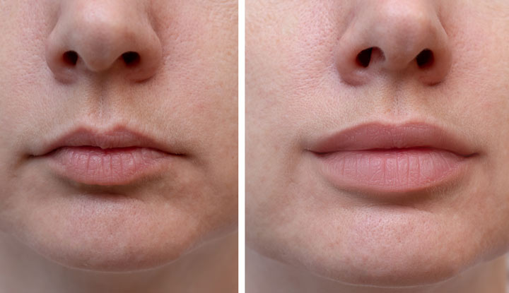 22133 lip fillers 1177813558 1