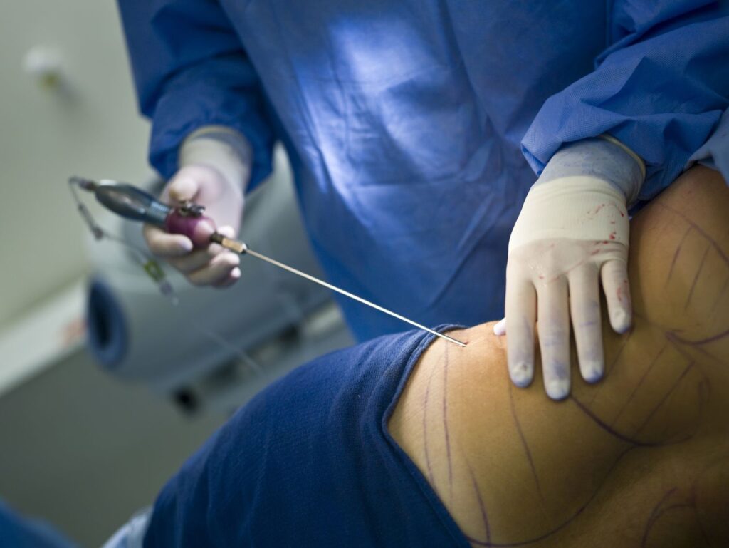 Laser liposuction in Dubai