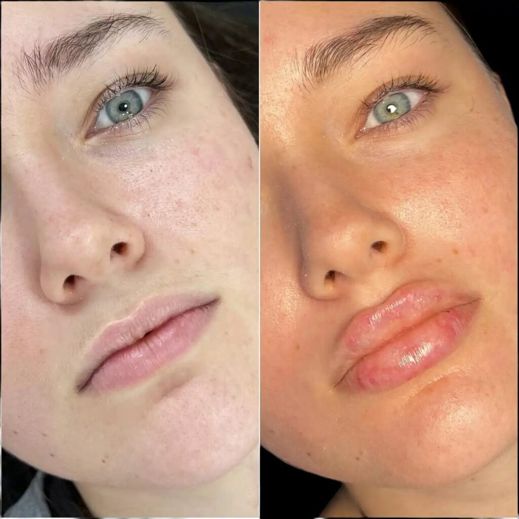 H1 lip fillers