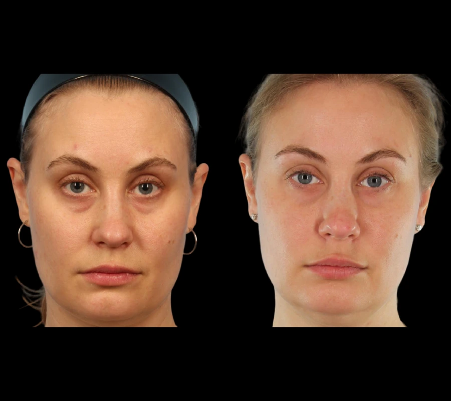H4 Under eye fillers