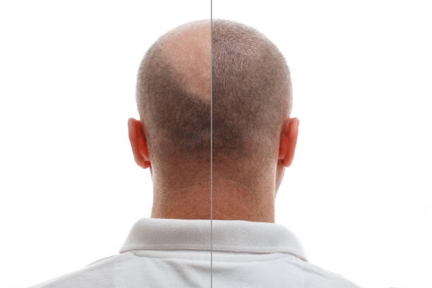 زراعة الشعر في الرياض