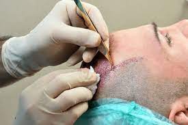 How Painful Is a Hair Transplant?