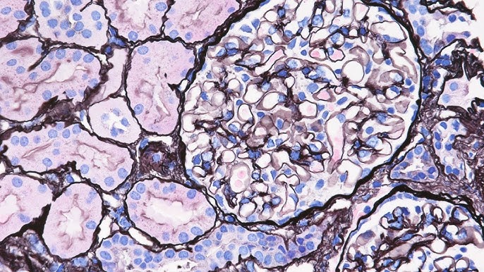 Minimal Change Kidney Disease