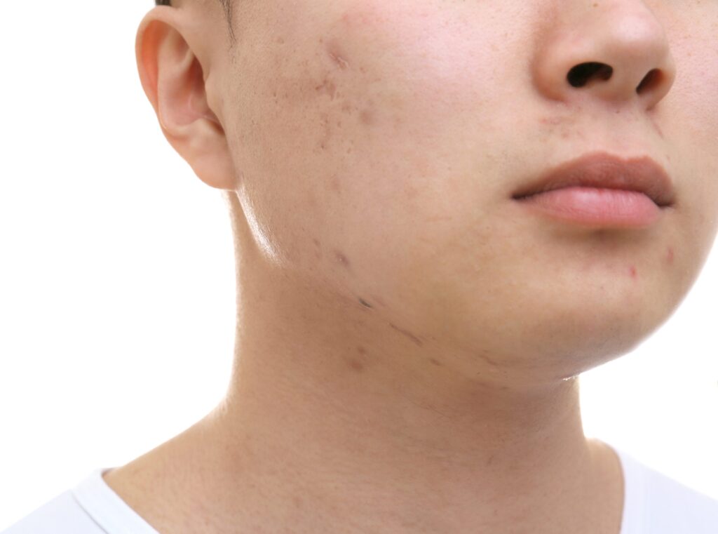 Acne Scar Treatment in Dubai