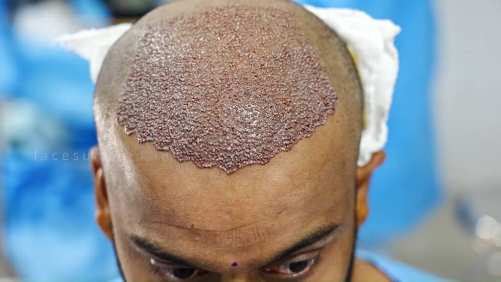 Hair Transplant in Dubai