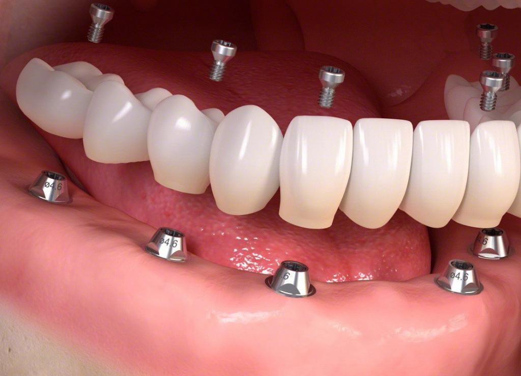 impianto dentale a Tirana / miglior clinica dentale albania
