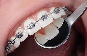 Align your smile today