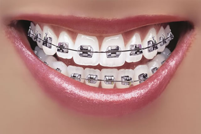 Align your teeth with modern braces