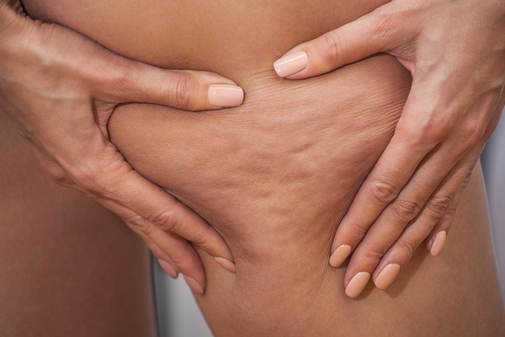Cellfina Treatment in Dubai