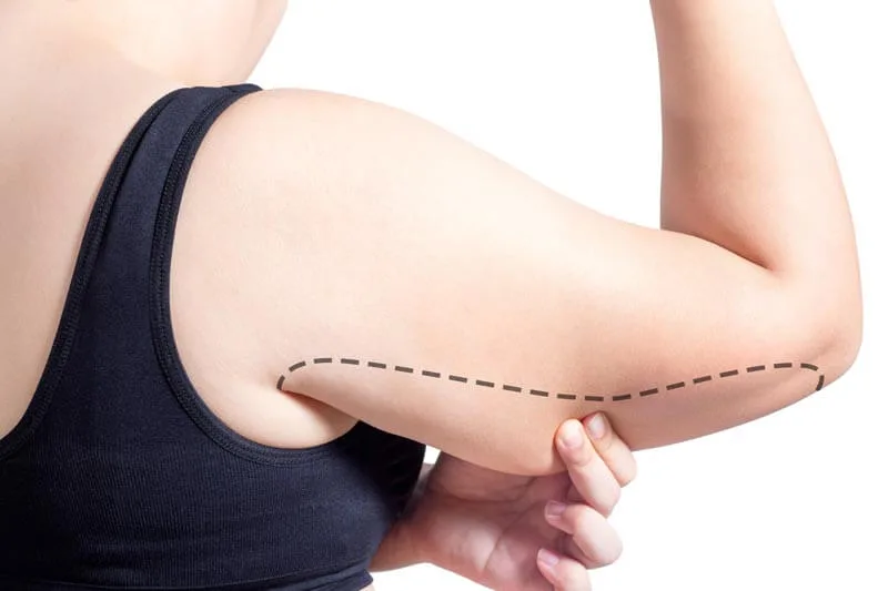 Combining Arm Lift with Other Body Contouring Surgeries