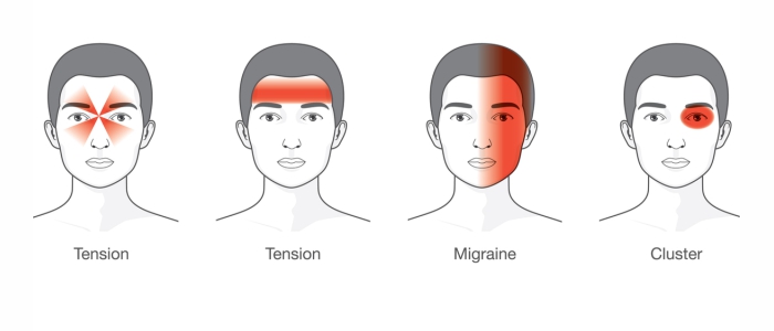 Different-Types-of-Headaches