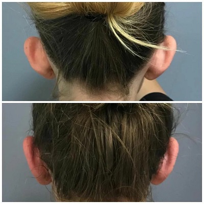 Ear Reshaping in Islamabad