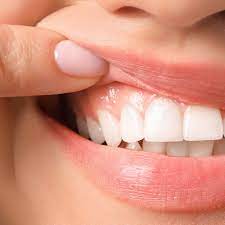 Excess Gum Removal