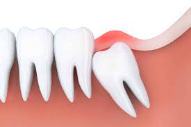 Extracting wisdom teeth