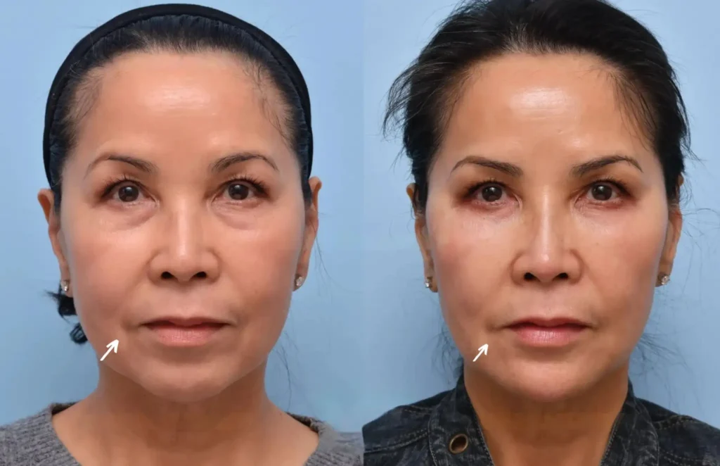 H23 botox