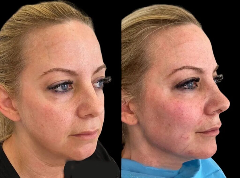 H3 Cheek Fillers 4