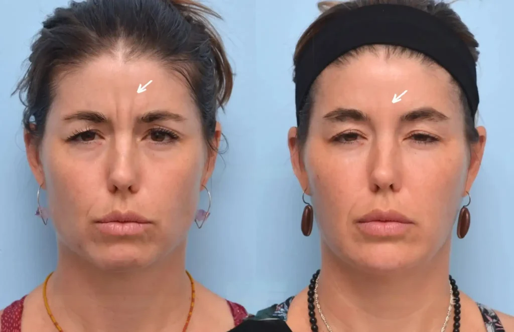 Botox in dubai