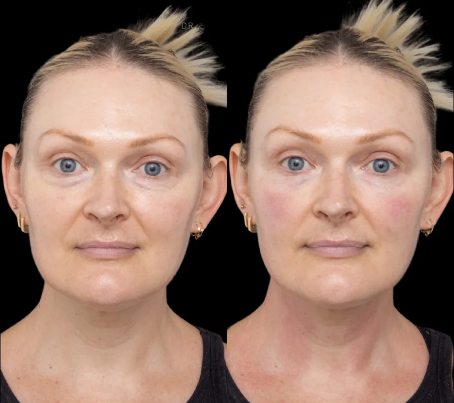 H5 Under eye fillers