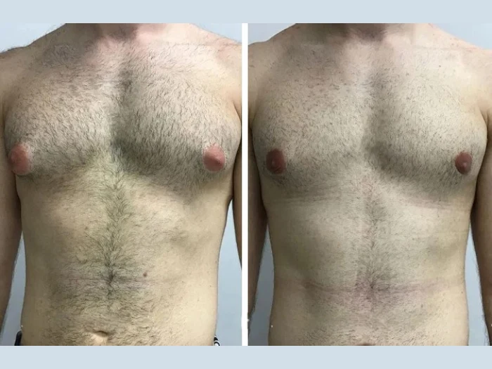 Recovery Timeline After Surgery for Gynecomastia in Dubai