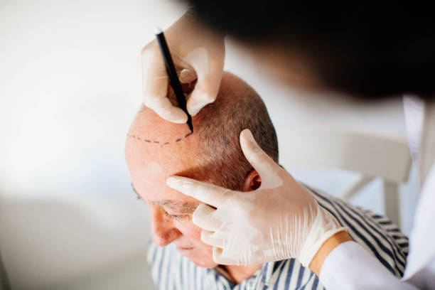 Hair Transplant in Riyadh