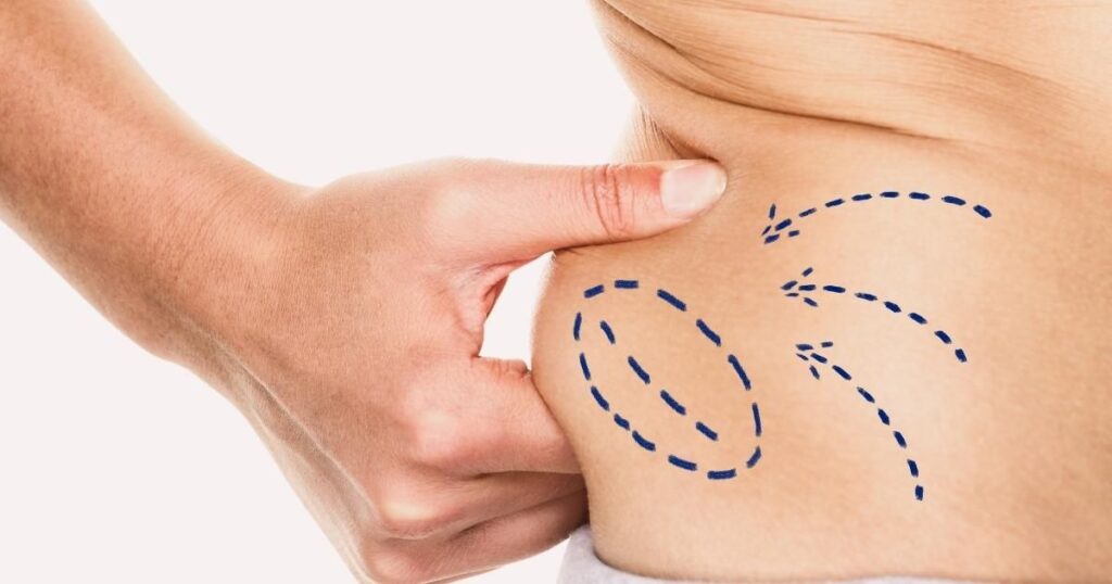 Liposuction