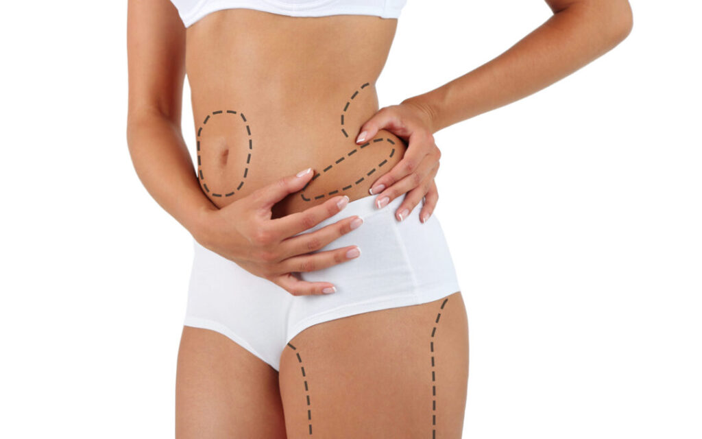 Liposuction in Islamabad