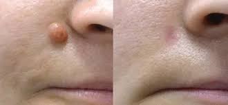 Mole Removal in Dubai