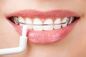 Orthodontic retainers