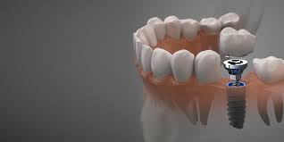 Smile bright with long lasting dental implants