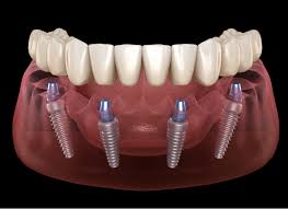 Smile makeover from root to crown
