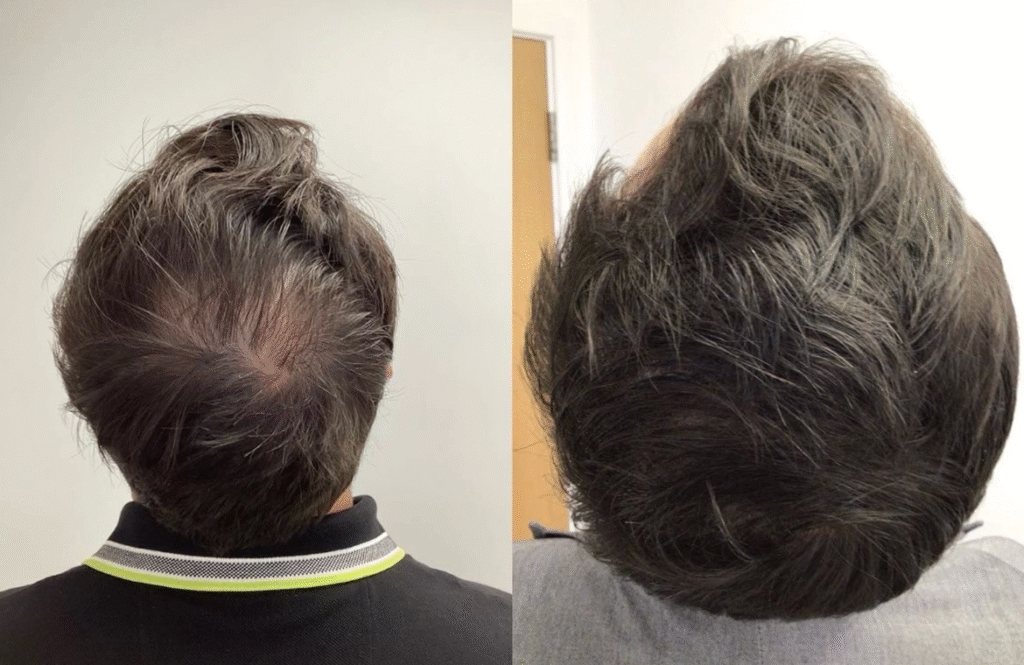 What’s the Safest Hair loss treatment in Dubai for Sensitive Scalps in Dubai?