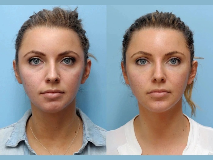 Thread Lift for Neck and Jawline: Achieve a Sculpted Look at the Best Aesthetic Clinic in Dubai