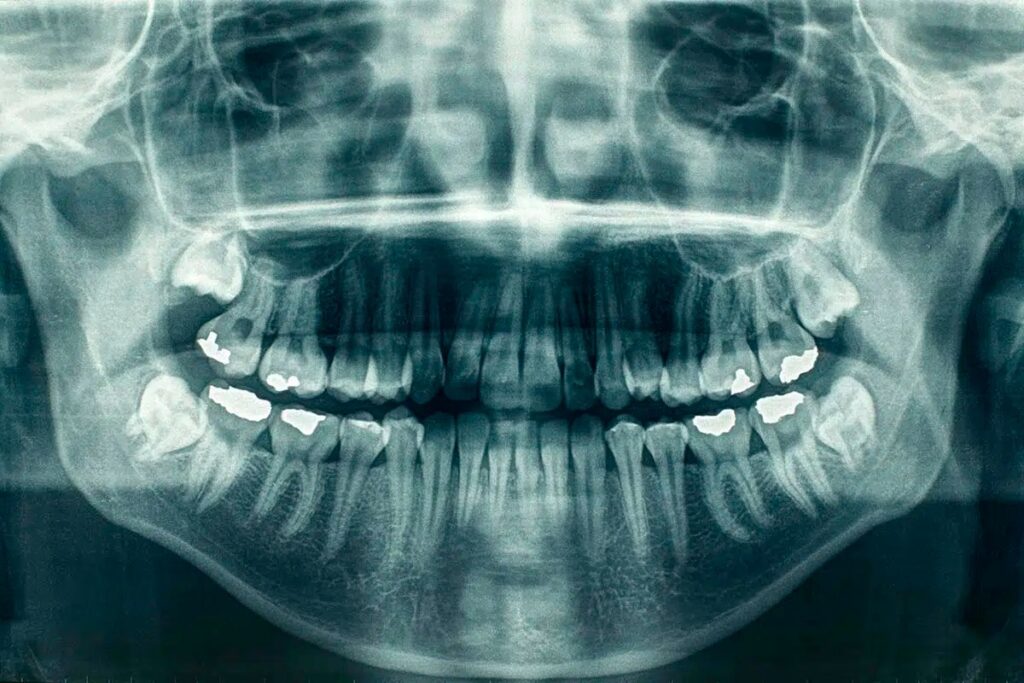 Panoramic Dental X-Ray Cost in Dubai
