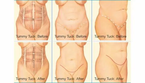 Discover the Best Tubeless Tummy Tuck in NYC: Your Ultimate Guide