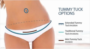 Best Tubeless Tummy Tuck in NYC – Safe, Scar-Minimized Results 2 Discover the Best Tubeless Tummy Tuck in NYC: Your Ultimate Guide