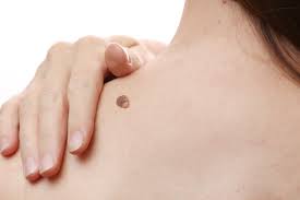 Skin Tag Removal in Dubai.