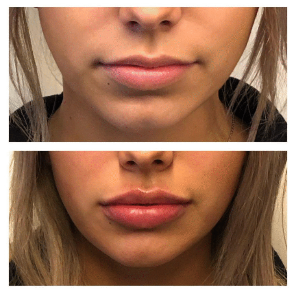lipfiller1