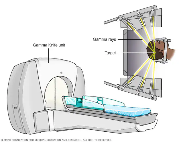 Patient Journey: What to Expect from Gamma Knife Radiosurgery in India