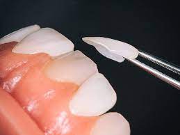 Brighten teeth with veneers