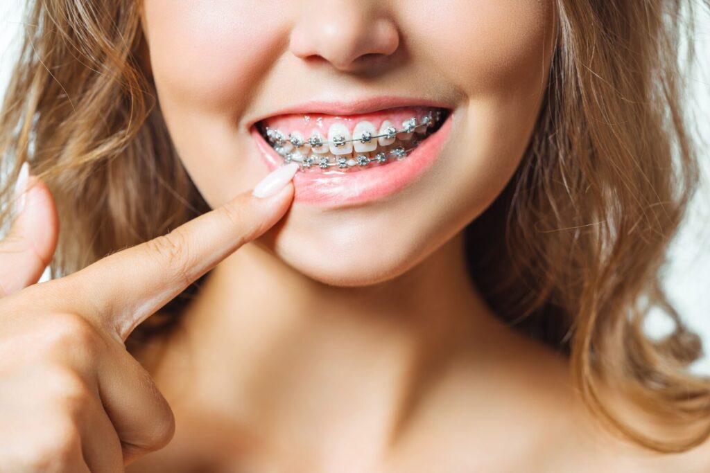 Dental Braces in Islamabad