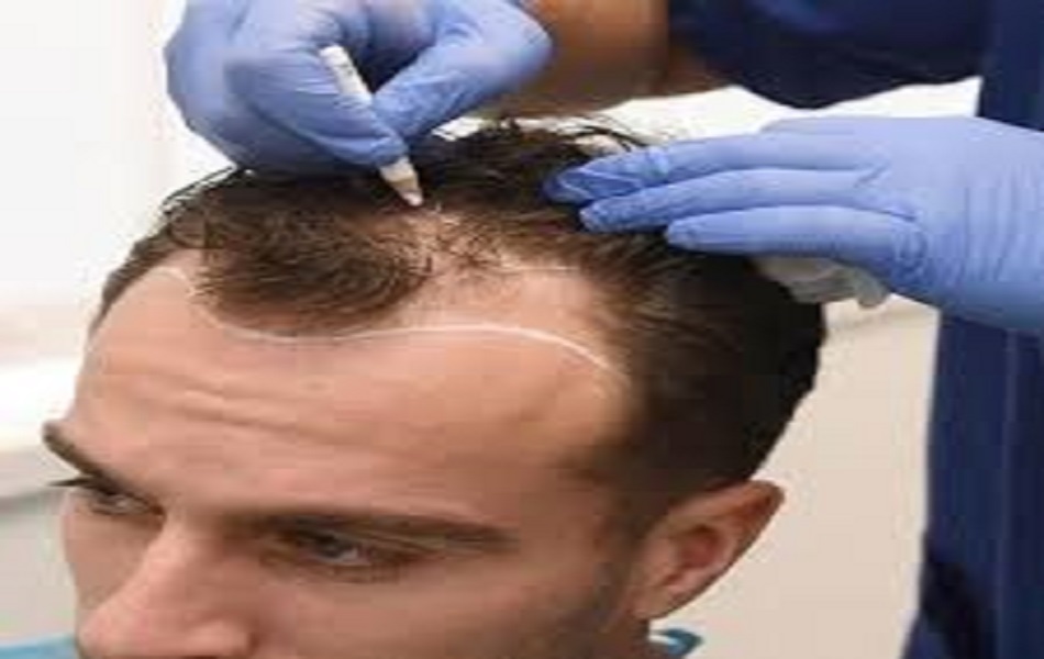 زراعة الشعر في الرياض