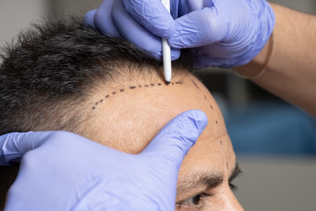 Hair Transplant